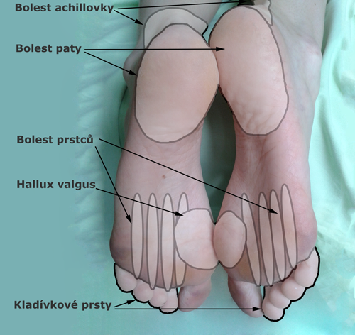 Časté obtíže - bolesti chodidel